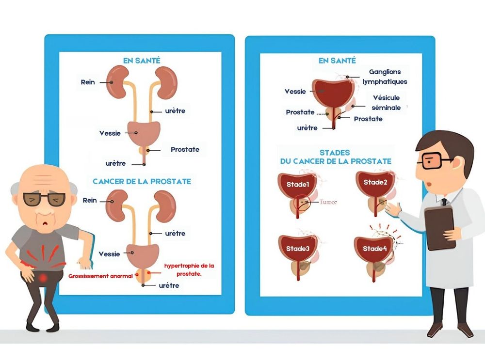 Cancer prostate : symptômes, dépistage et traitements